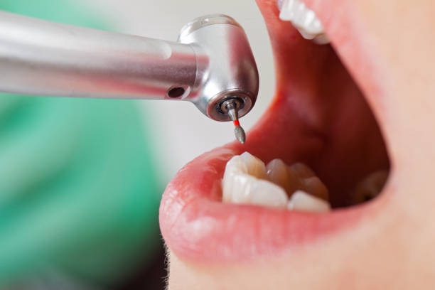 Best Chipped Tooth Repair Near Me  in First Mesa, AZ